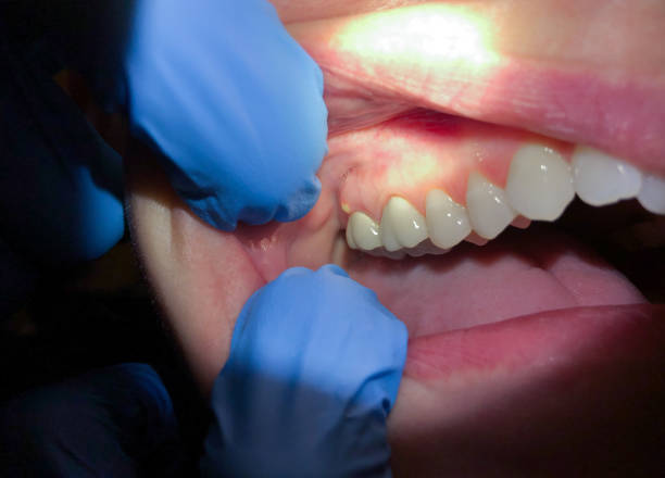Best Emergency Cosmetic Dentistry (e.g., broken veneers) in Lake Goodwin, WA