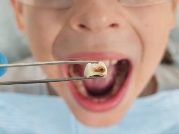 Best Emergency Treatment for Oral Infections in Lake Goodwin, WA